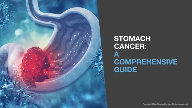 Portada de Stomach Cancer: A Comprehensive Guide